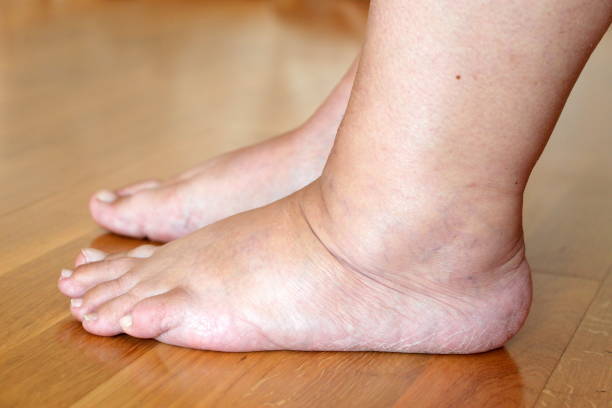 Related Article - Heat Edema: Causes, Symptoms, and How to Cure?